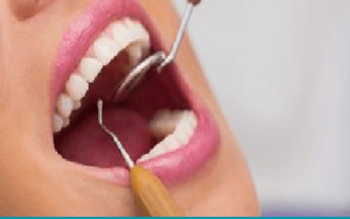 Tártato nos dentes, como cuidar para evitar caries e doenças gengivais!